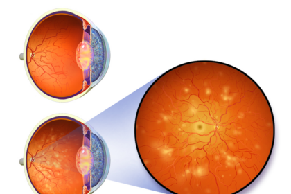 Diabetic retinopathy eye disease showing damaged retinal blood vessels