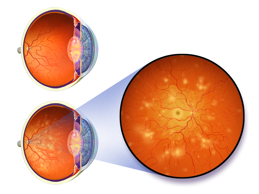 Diabetic retinopathy eye disease showing damaged retinal blood vessels