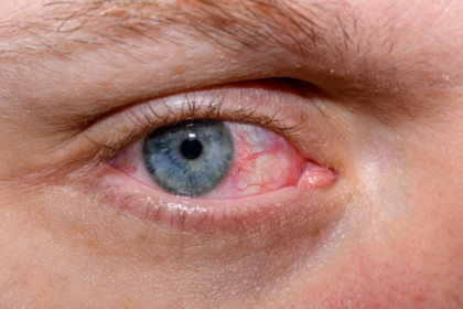 ਡਰਾਈ ਆਇਜ਼ ਦੇ ਲੱਛਣ – ਅੱਖਾਂ ਦੀ ਸੁੱਕਣੀ ਸਮੱਸਿਆ