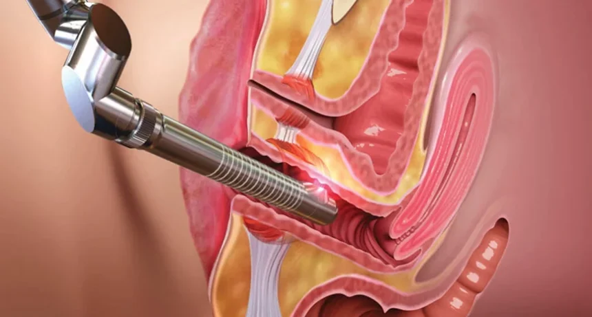 Cosmetic Laser Rejuvenation in Gynae Cosmetic Surgery