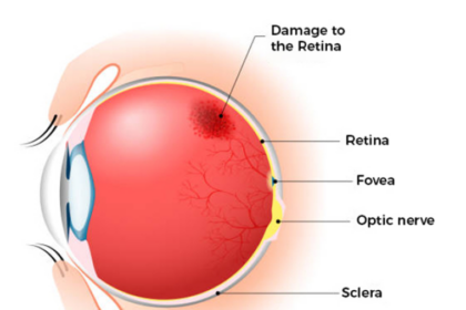 Vitreo-retinal disorders affecting the retina and vitreous causing vision loss