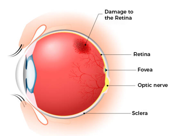 Vitreo-retinal disorders affecting the retina and vitreous causing vision loss