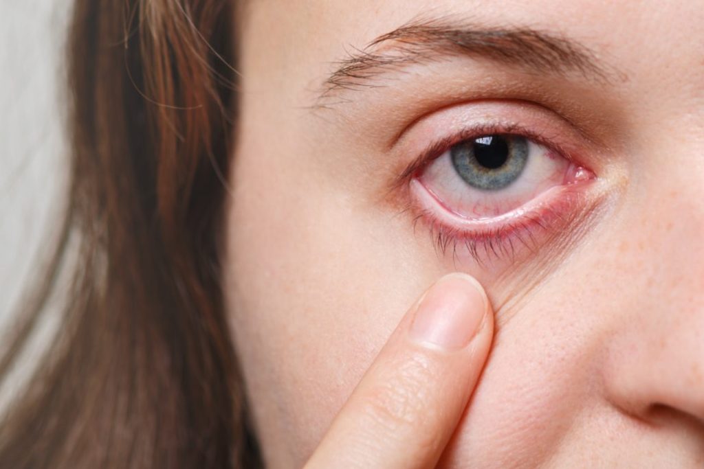 Common symptoms of dry eye disease including redness, irritation and blurred vision
